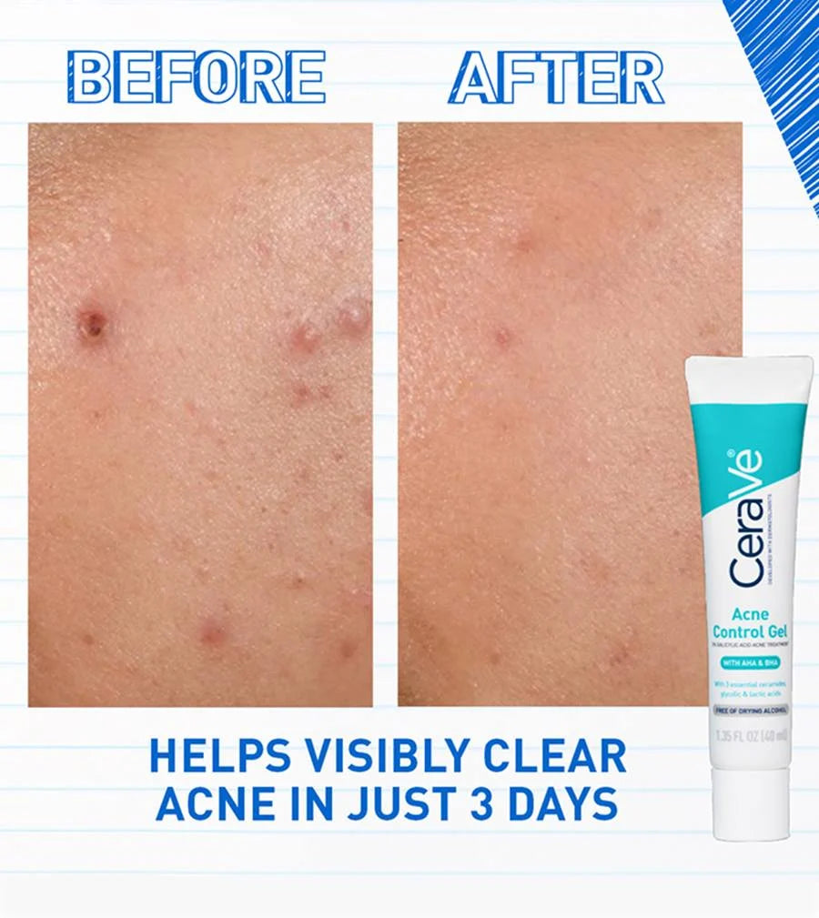 Acne Control Gel